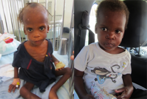 Edanson before_after